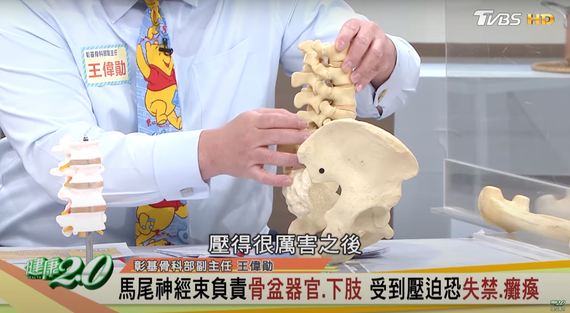 骨科副主任 王偉勛醫師解說正常脊椎與被壓迫的脊椎分別（截自YouTube@健康2.0《這種下背痛不能等 馬尾症候群影響解尿.排便.性功能》）