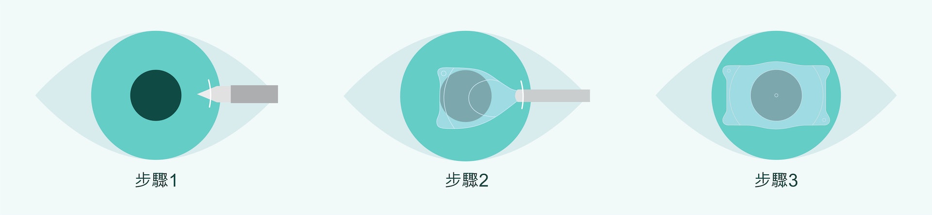 手術步驟:1)在角膜切開一個於3mm傷口 2)植入ICL鏡片於虹膜與晶狀體之間 3)調整及固定鏡片位置 手術步驟:1)在角膜切開一個於3mm傷口 2)植入ICL鏡片於虹膜與晶狀體之間 3)調整及固定鏡片位置