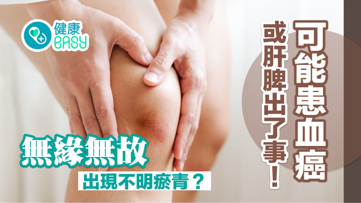 癌症|無緣無故出現不明瘀青?可能患血癌或肝脾出了事! 癌症|無緣無故出現不明瘀青?可能患血癌或肝脾出了事!