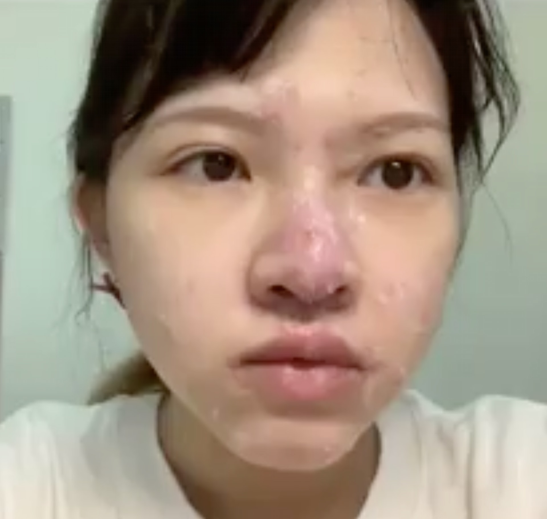 在長水痘過後令臉上多了凹疤,驚呼:「成人水痘害我毀容!」(Dcard) 在長水痘過後令臉上多了凹疤,驚呼:「成人水痘害我毀容!」(Dcard)