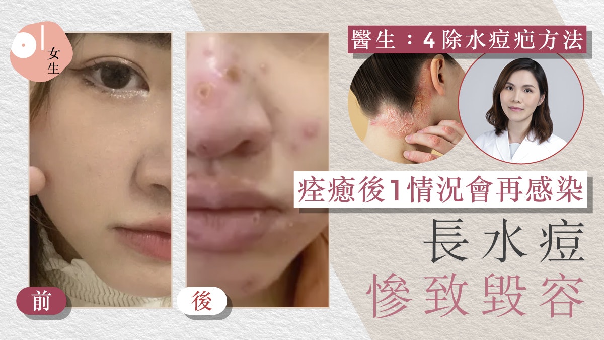 女網民長水痘慘喊毀容了!醫生:成人徵狀更嚴重、長過有機會再現 女網民長水痘慘喊毀容了!醫生:成人徵狀更嚴重、長過有機會再現