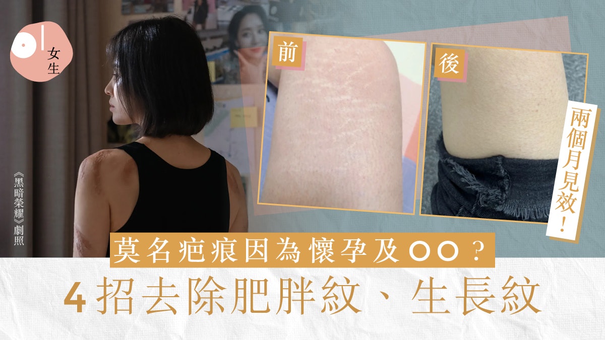 肥胖紋消除方法|4招有效擊退生長紋 網民實測兩個多月成功消除 肥胖紋消除方法|4招有效擊退生長紋 網民實測兩個多月成功消除
