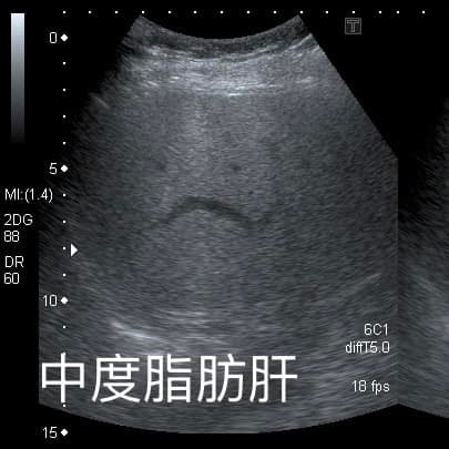 台湾1名6旬妇去年仍患中度脂肪肝，但只靠「少吃水果」，短短1年就减重10公斤，连肝脏也恢复正常。从图片可见，肝脏有脂肪在超音波下会显得颜色偏白。（「钱政弘 胃肠肝胆科医师」FB图片）