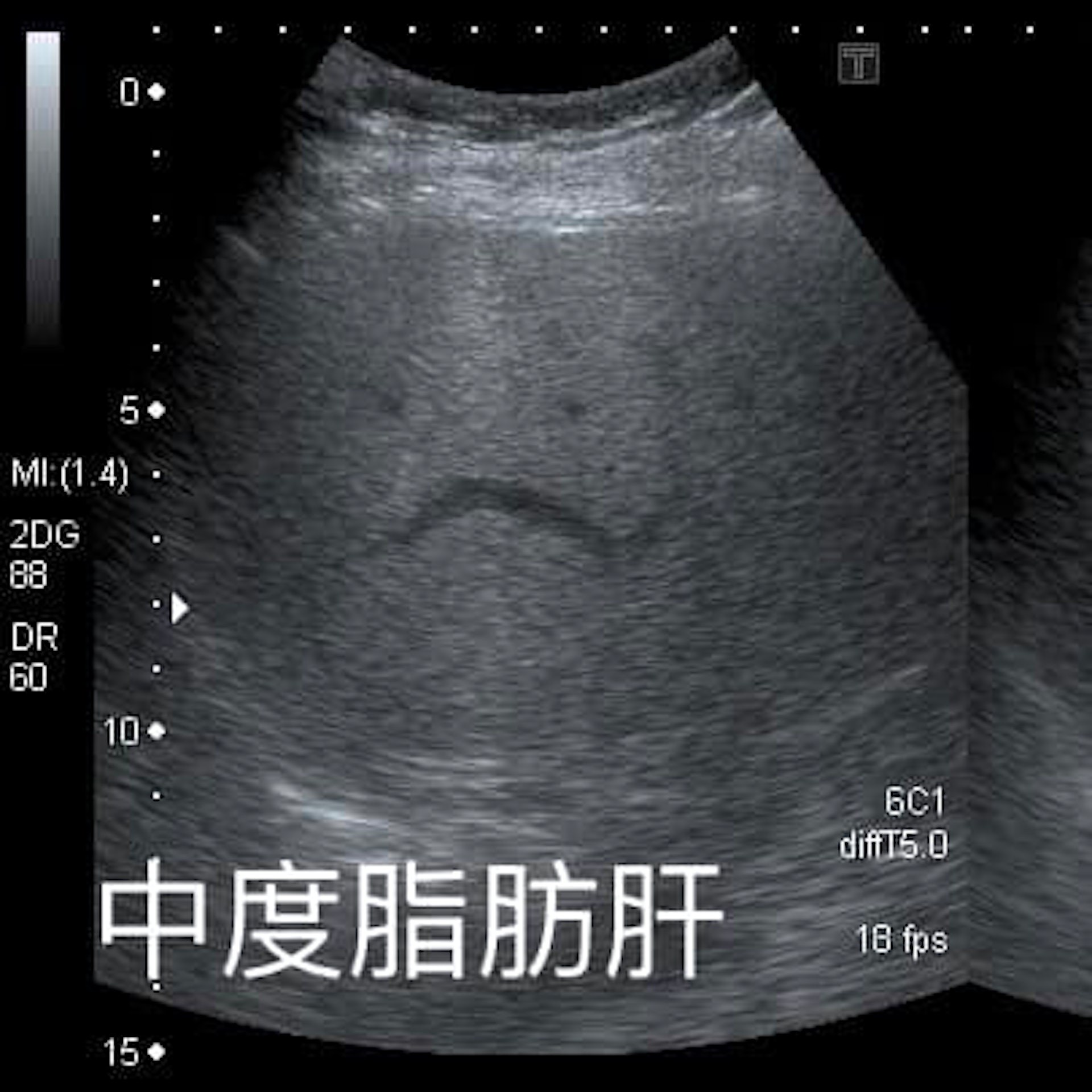 台灣1名6旬婦去年仍患中度脂肪肝，但只靠「少吃水果」，短短1年就減重10公斤，連肝臟也恢復正常。從圖片可見，肝臟有脂肪在超音波下會顯得顏色偏白。（「錢政弘 胃腸肝膽科醫師」FB圖片）