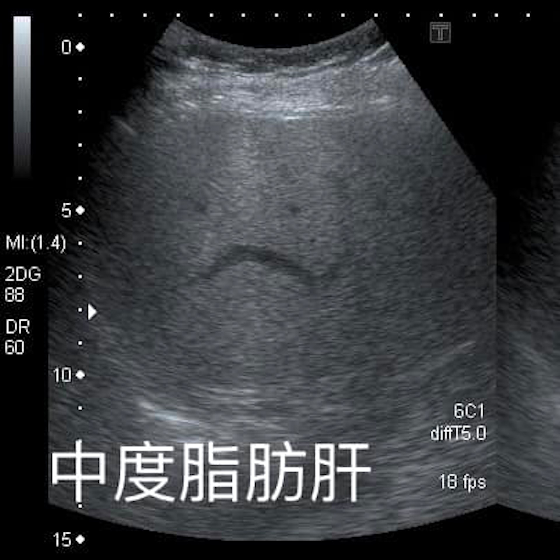 台灣1名6旬婦去年仍患中度脂肪肝,但只靠「少吃水果」,短短1年就減重10公斤,連肝臟也恢復正常。從圖片可見,肝臟有脂肪在超音波下會顯得顏色偏白。(「錢政弘 胃腸肝膽科醫師」FB圖片) 台灣1名6旬婦去年仍患中度脂肪肝,但只靠「少吃水果」,短短1年就減重10公斤,連肝臟也恢復正常。從圖片可見,肝臟有脂肪在超音波下會顯得顏色偏白。(「錢政弘 胃腸肝膽科醫師」FB圖片)