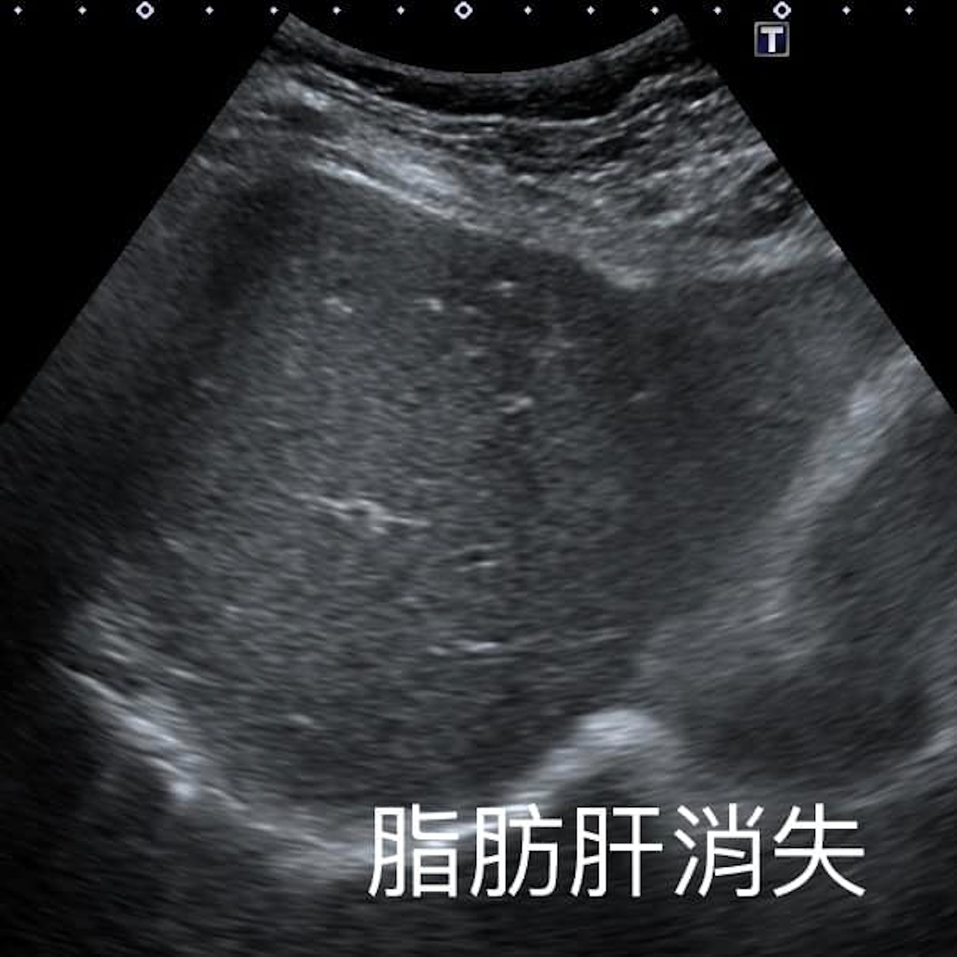 覆診時,醫生發時婦人的脂肪肝已經消失。從超聲波可見,脂肪消失後肝臟就恢復深色。(「錢政弘 胃腸肝膽科醫師」FB圖片) 覆診時,醫生發時婦人的脂肪肝已經消失。從超聲波可見,脂肪消失後肝臟就恢復深色。(「錢政弘 胃腸肝膽科醫師」FB圖片)