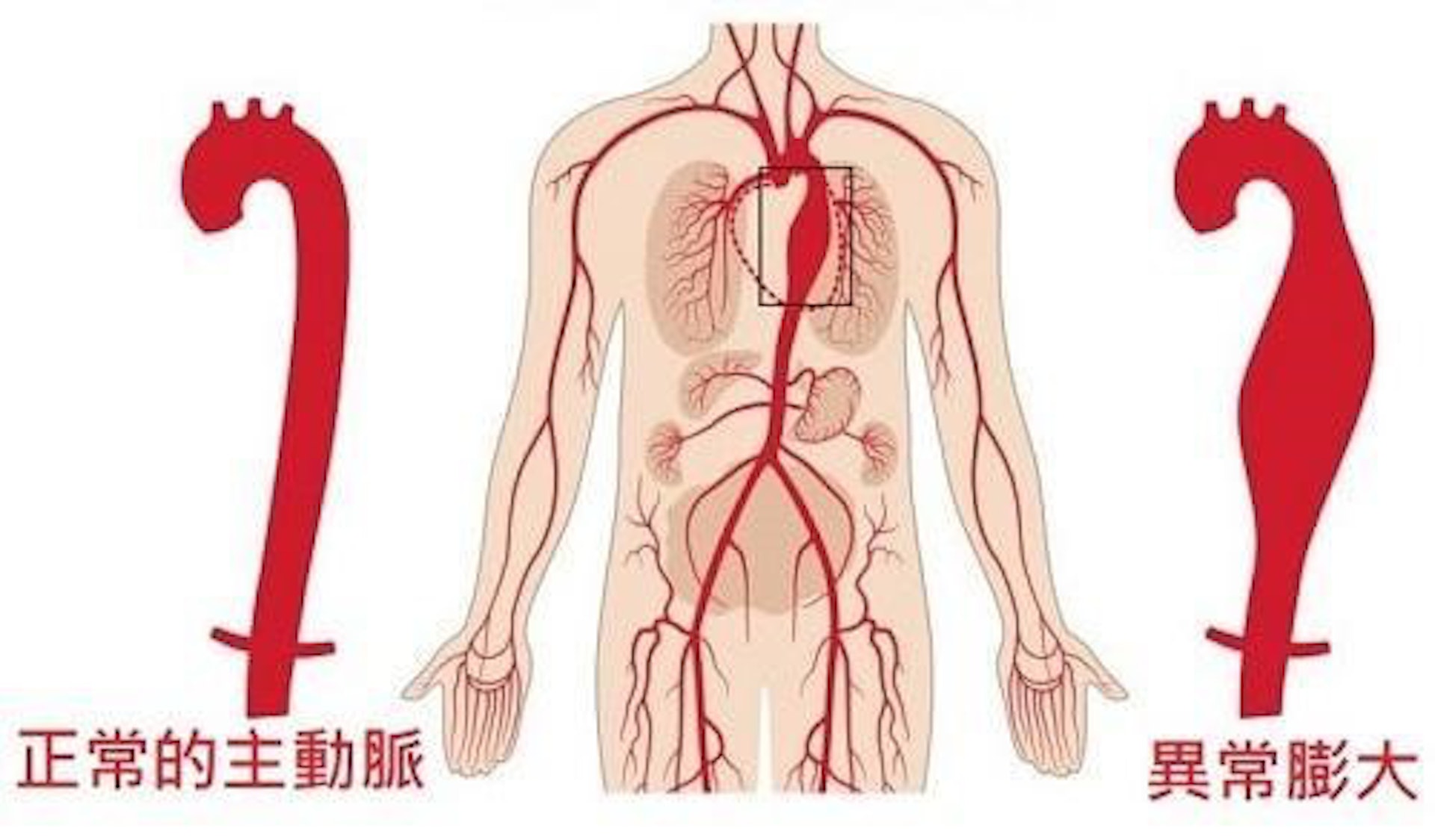 血管瘤並非癌症腫瘤,而是指血管出現退化,令該退化血管位置猶如氣球般膨脹。(圖片:wlshosp) 血管瘤並非癌症腫瘤,而是指血管出現退化,令該退化血管位置猶如氣球般膨脹。(圖片:wlshosp)