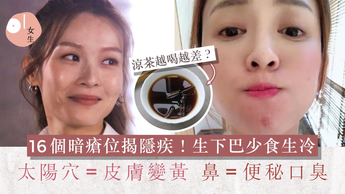 暗瘡位置16個揭這些身體隱疾?中醫拆解4大暗瘡成因+去暗瘡食物 暗瘡位置16個揭這些身體隱疾?中醫拆解4大暗瘡成因+去暗瘡食物