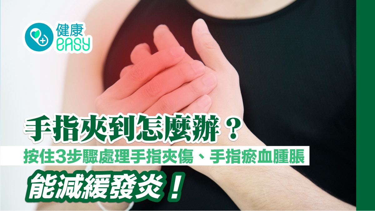 家居意外|3步驟處理手指夾傷、手指瘀血腫脹 這樣做減緩發炎