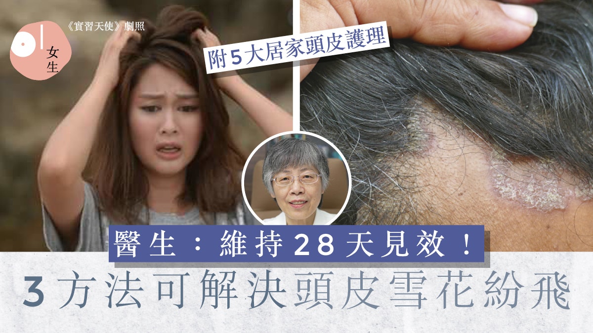 頭皮護理|這原因令頭皮常出現?醫生:3大頭皮壞習慣+解決方法 頭皮護理|這原因令頭皮常出現?醫生:3大頭皮壞習慣+解決方法