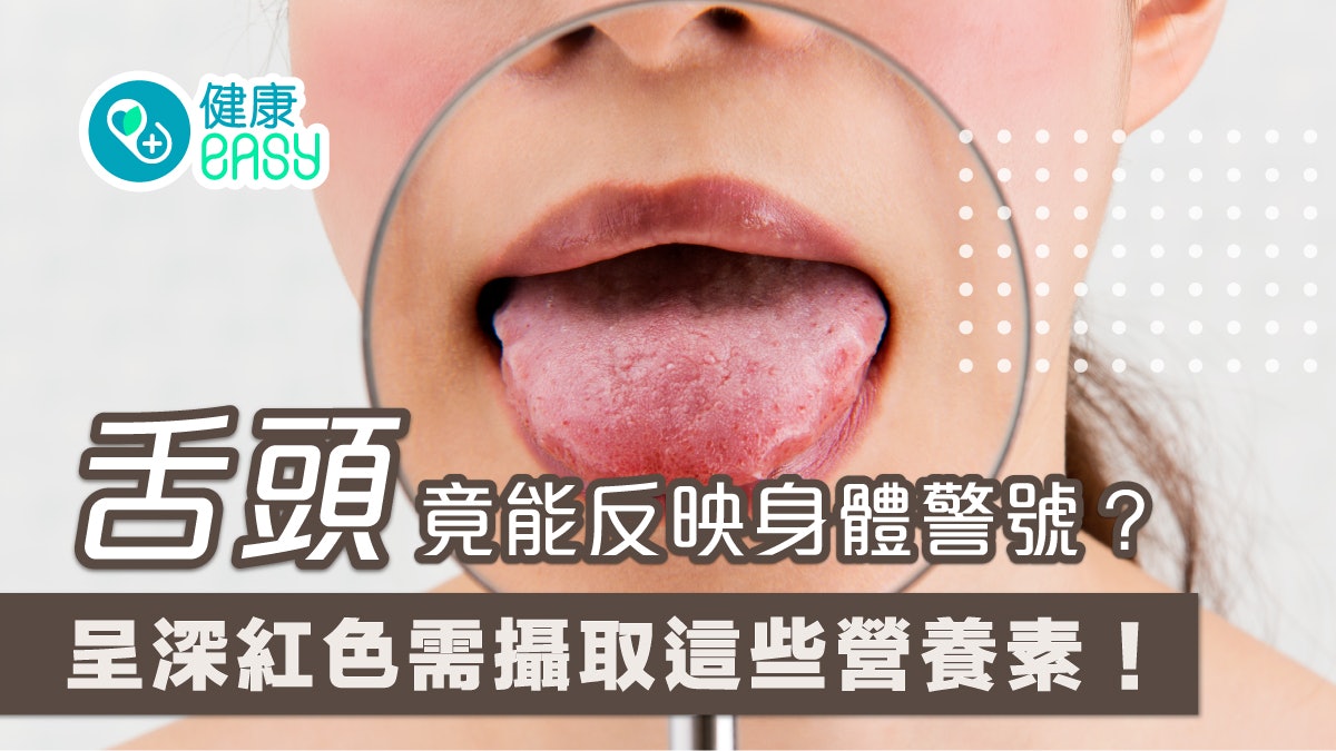 口腔健康|4種舌頭狀況身體正響警號 呈深紅色需攝取這些營養素 口腔健康|4種舌頭狀況身體正響警號 呈深紅色需攝取這些營養素