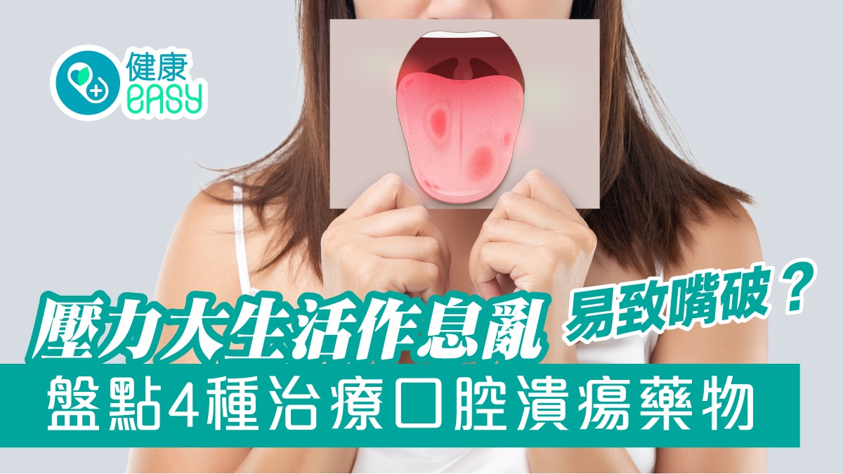 生痱滋|壓力大生活作息亂易致嘴破?盤點4種治療口腔潰瘍藥物 生痱滋|壓力大生活作息亂易致嘴破?盤點4種治療口腔潰瘍藥物