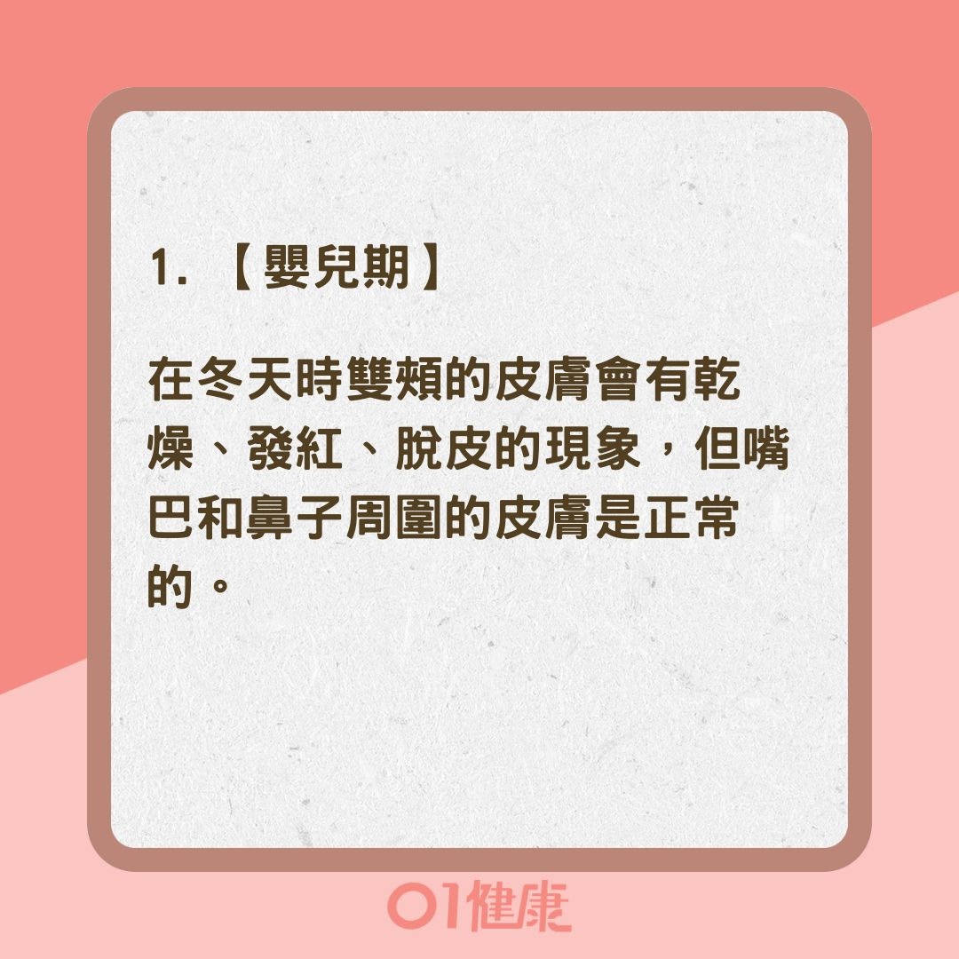 濕疹不同年齡症狀特徵大不同（01製圖）