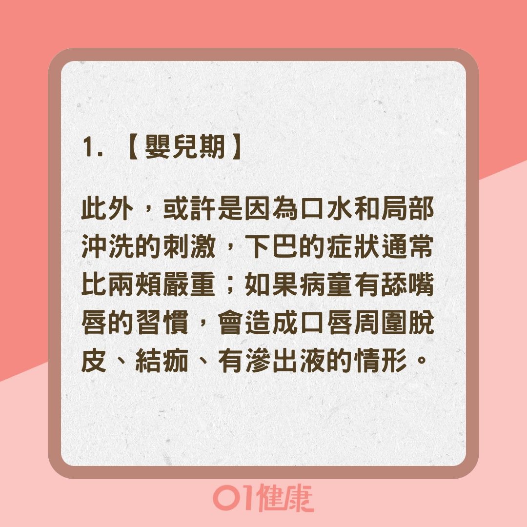 濕疹不同年齡症狀特徵大不同（01製圖）