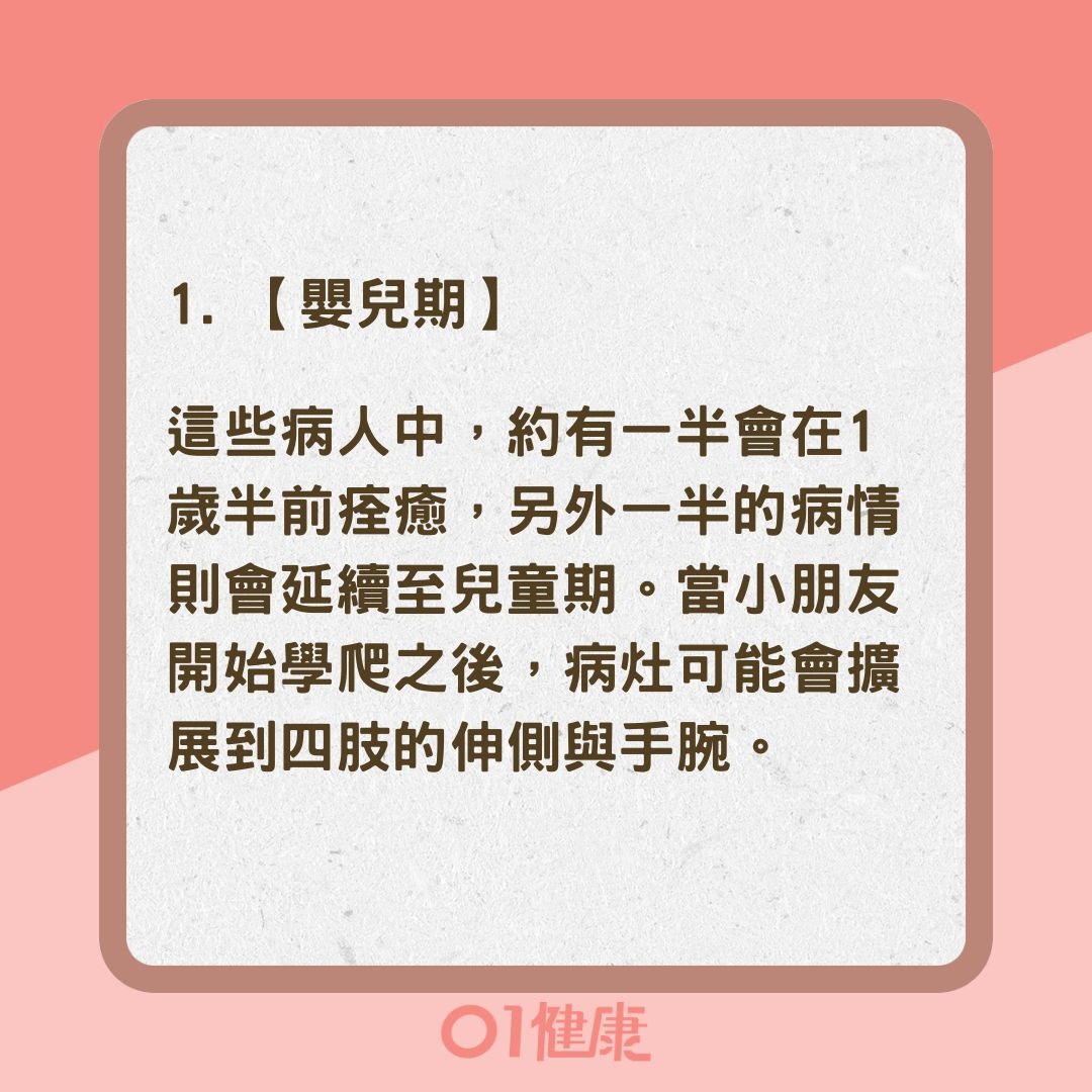 濕疹不同年齡症狀特徵大不同（01製圖）