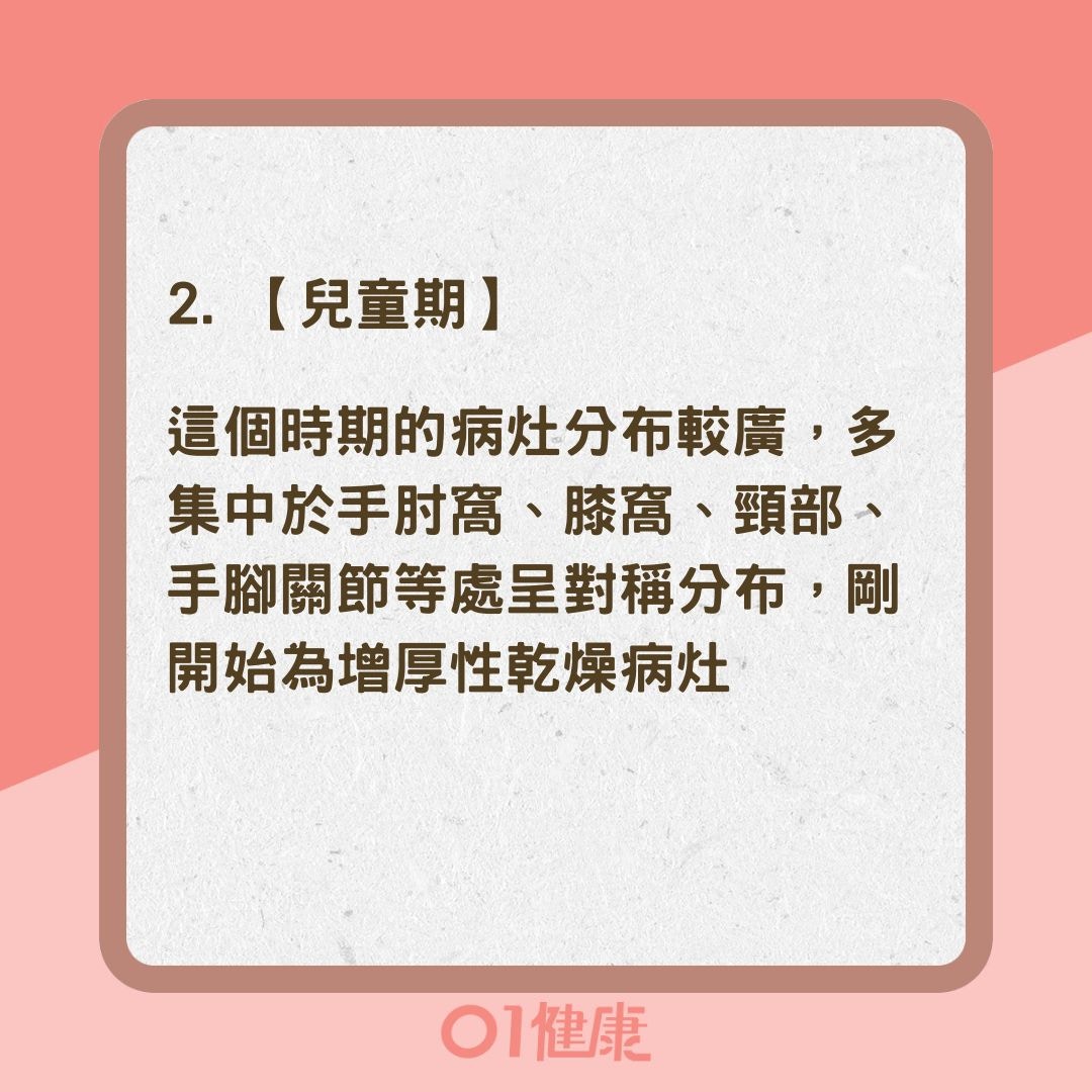 濕疹不同年齡症狀特徵大不同（01製圖）