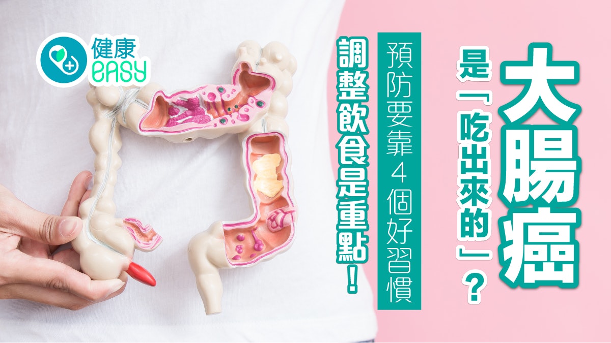 大腸癌|早期無明顯症狀易錯過黃金治療期!預防要靠4個好習慣 大腸癌|早期無明顯症狀易錯過黃金治療期!預防要靠4個好習慣