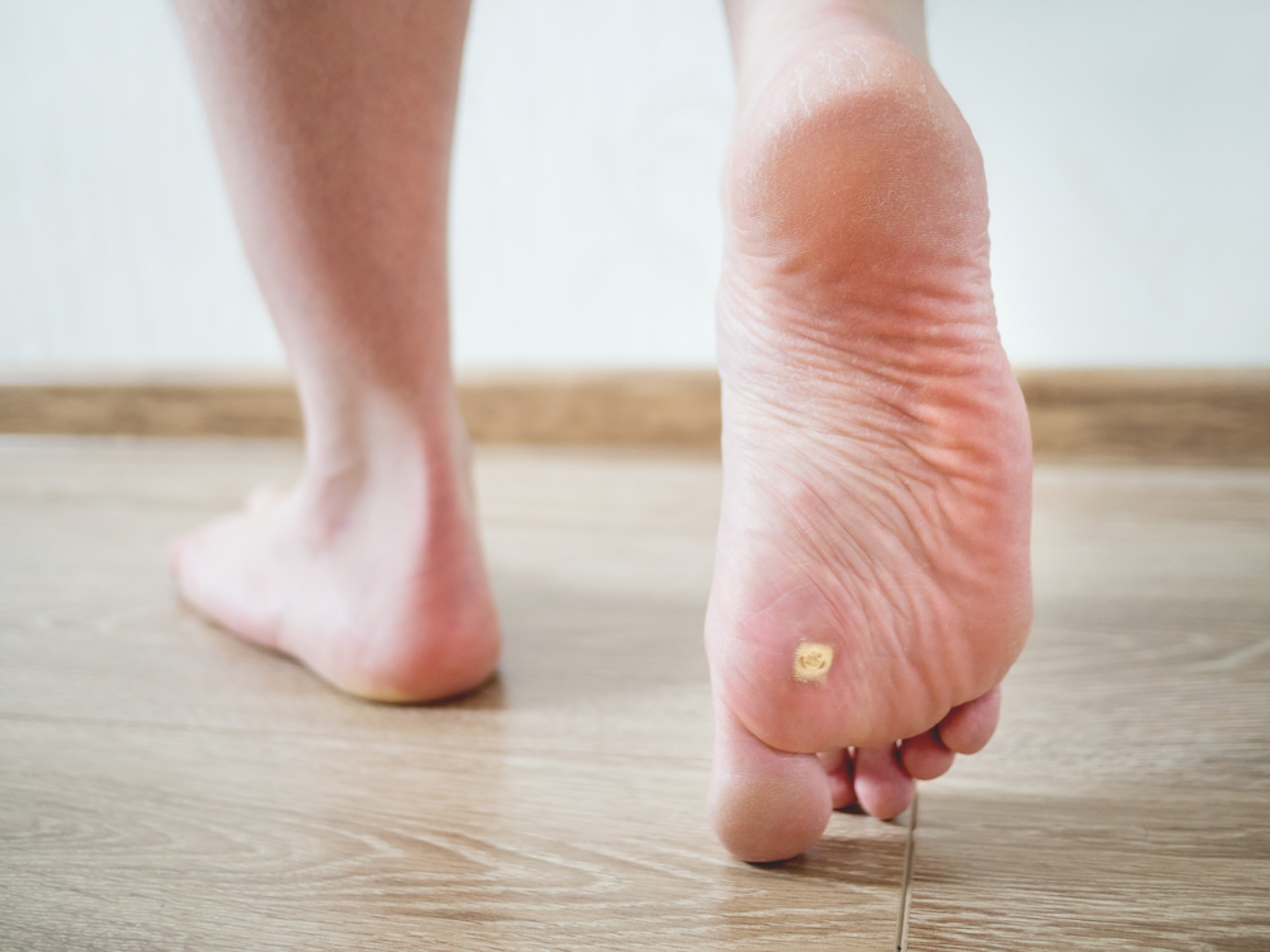 跖疣通常長在足部經常受壓力的地方，較為堅硬，致患者步行時感到疼痛。（圖片：Shutterstock）