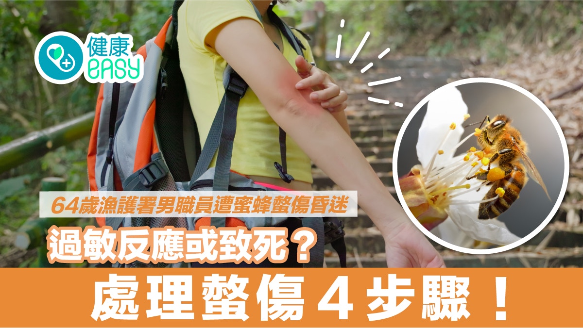 螫傷｜一日兩宗遭蜂螫！過敏反應或致死？學會處理螫傷４大步驟