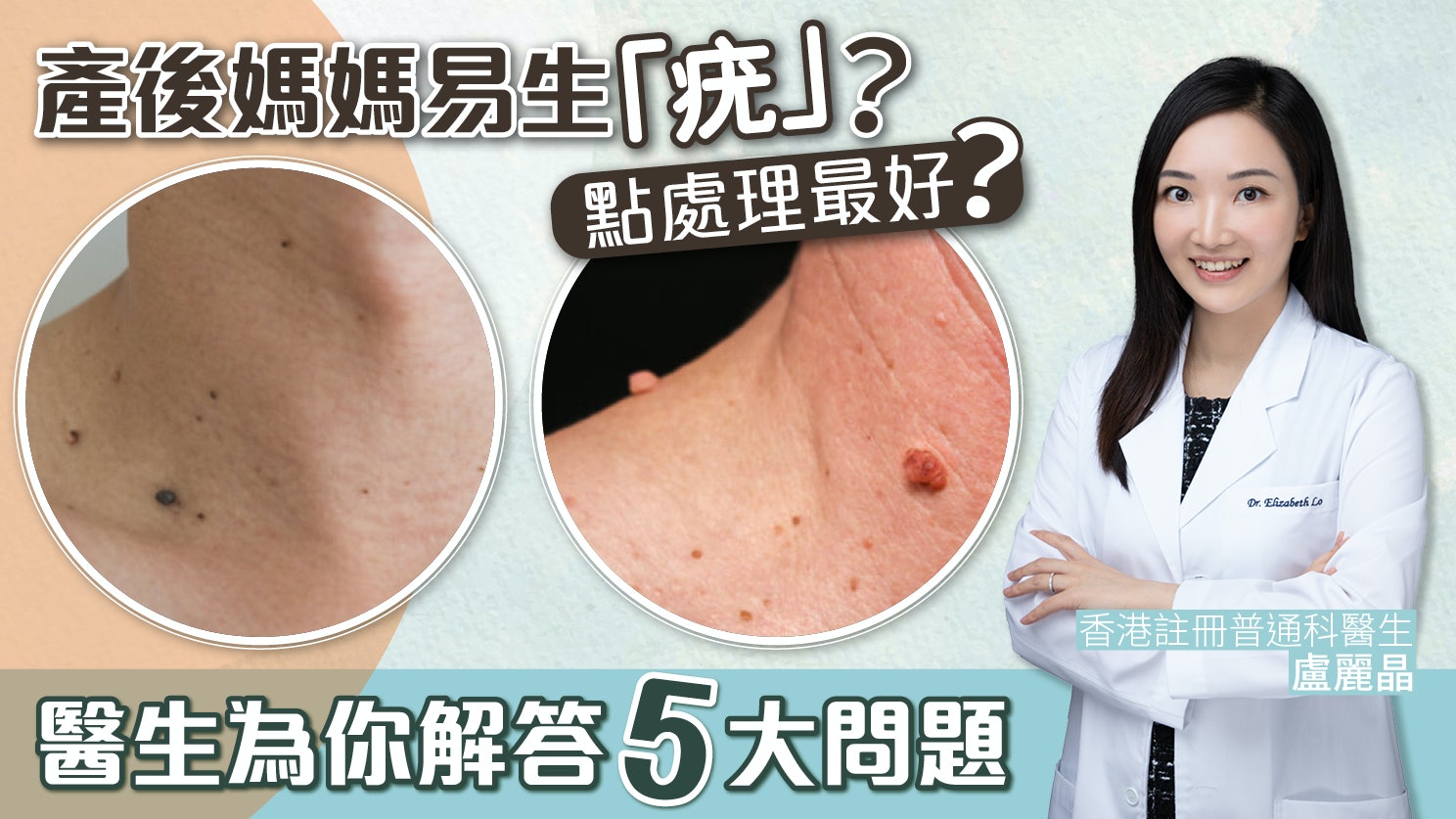 產後媽媽易生「疣」?點處理最好?醫生為你解答5大問題 產後媽媽易生「疣」?點處理最好?醫生為你解答5大問題