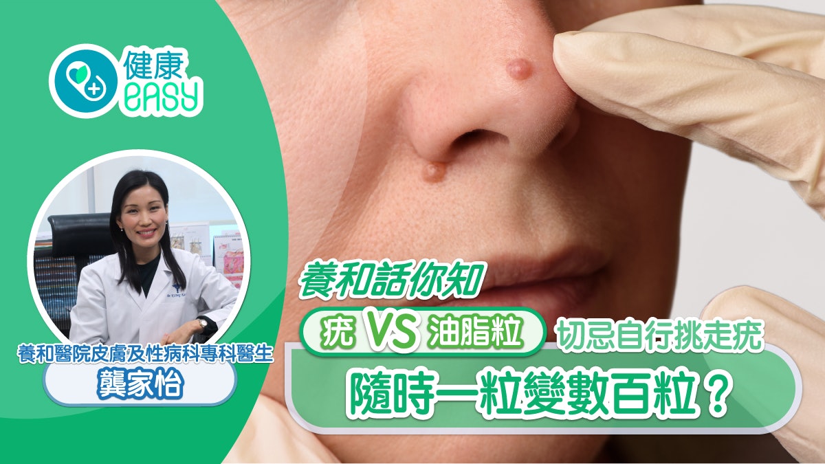 養和話你知丨疣VS油脂粒 切忌自行挑走疣 隨時一粒變數百粒? 養和話你知丨疣VS油脂粒 切忌自行挑走疣 隨時一粒變數百粒?