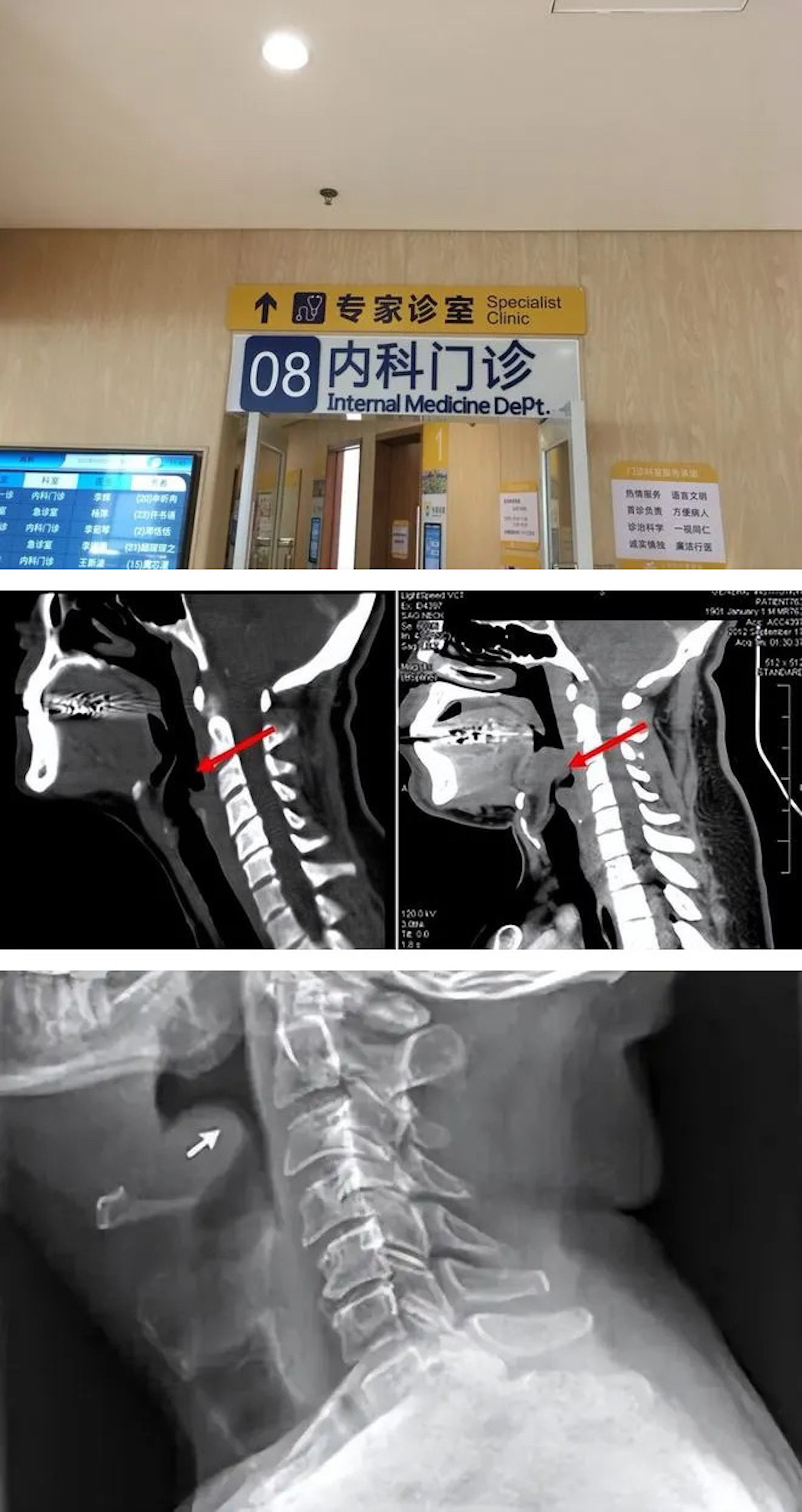 內地近日流傳1名26歲女子由打邊爐後感到喉嚨不適,至翌日求診後搶救不治的經歷,從她到達醫院就診到離世的過程僅僅10分鐘。(網上圖片) 內地近日流傳1名26歲女子由打邊爐後感到喉嚨不適,至翌日求診後搶救不治的經歷,從她到達醫院就診到離世的過程僅僅10分鐘。(網上圖片)