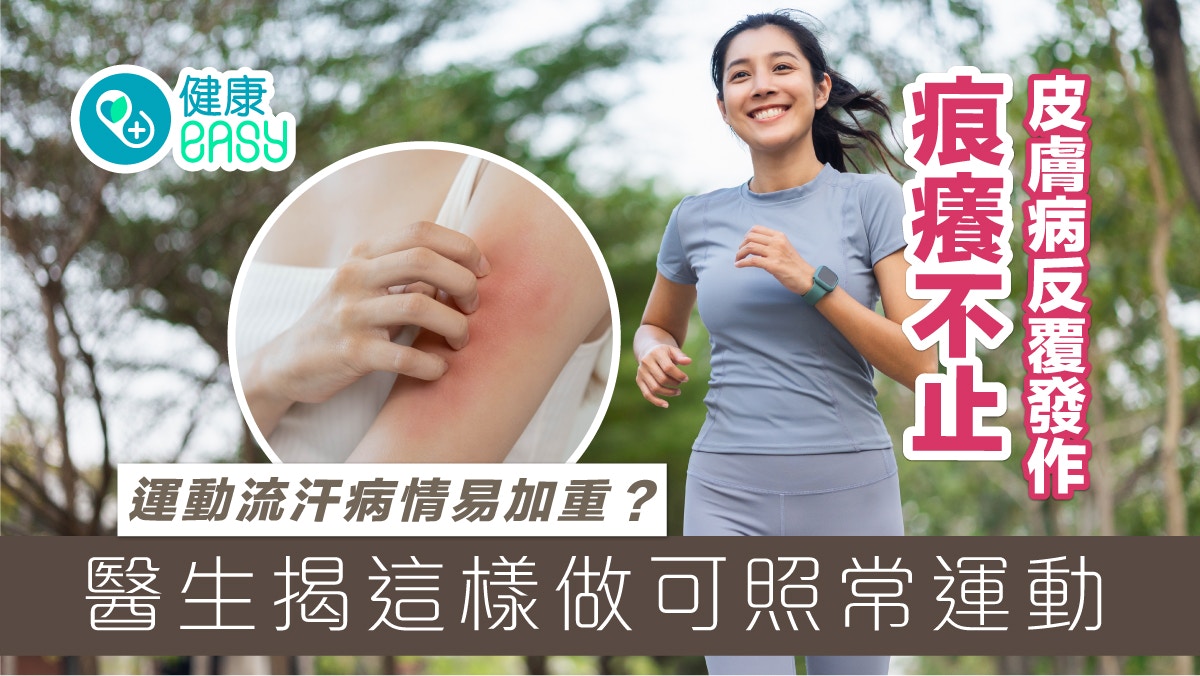 皮膚健康｜皮膚病反覆發作怕運動流汗更癢？醫揭這樣做可照常運動