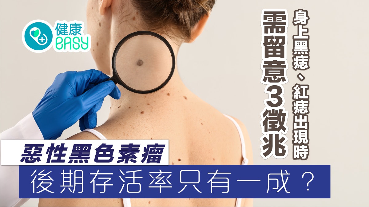 黑色素瘤|身上黑痣、紅痣出現3徵兆 醫生:小心惡性度很高癌症 黑色素瘤|身上黑痣、紅痣出現3徵兆 醫生:小心惡性度很高癌症