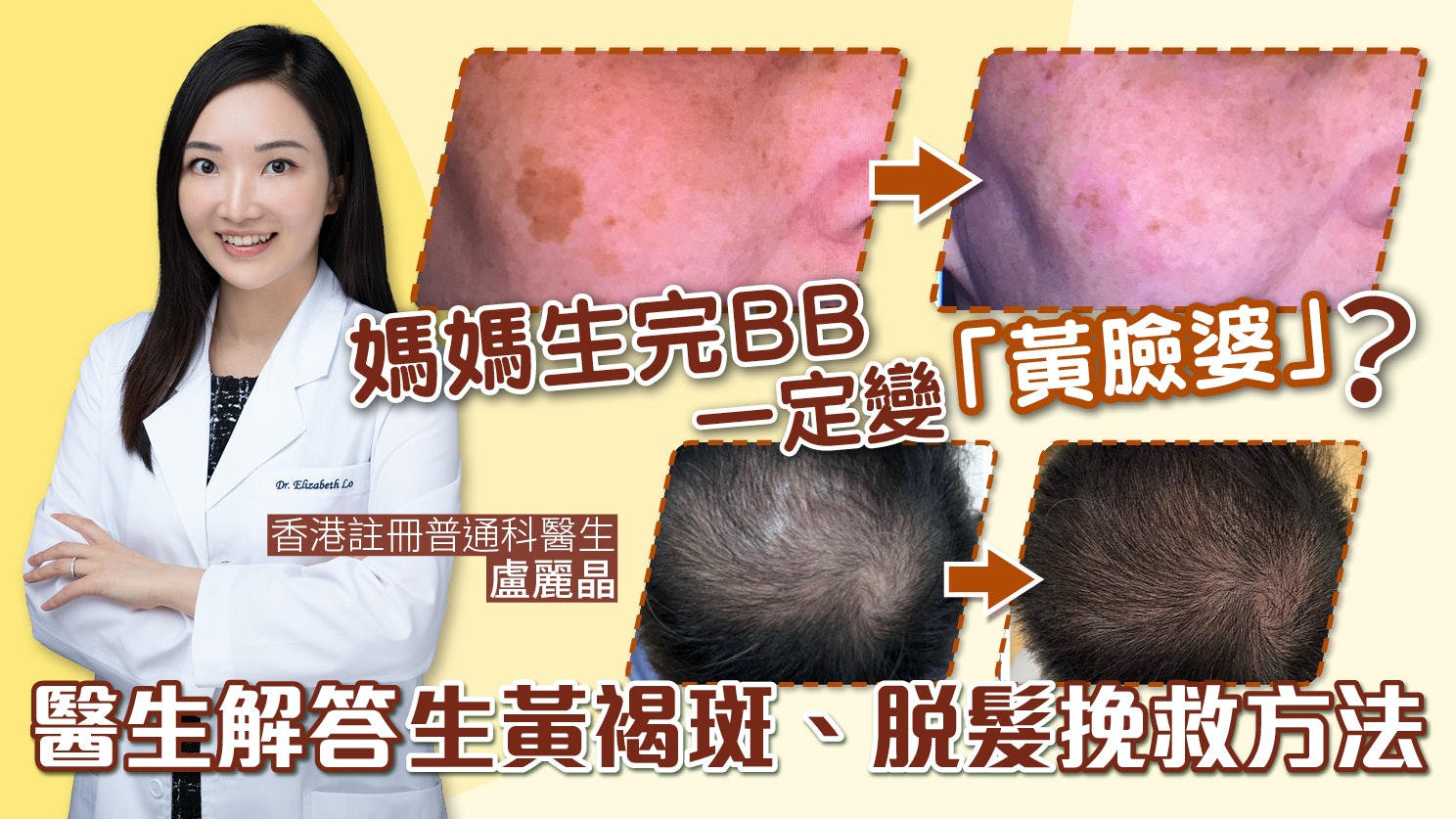 媽媽生完BB一定變「黃臉婆」?醫生解答生黃褐斑、脫髮挽救方法 媽媽生完BB一定變「黃臉婆」?醫生解答生黃褐斑、脫髮挽救方法