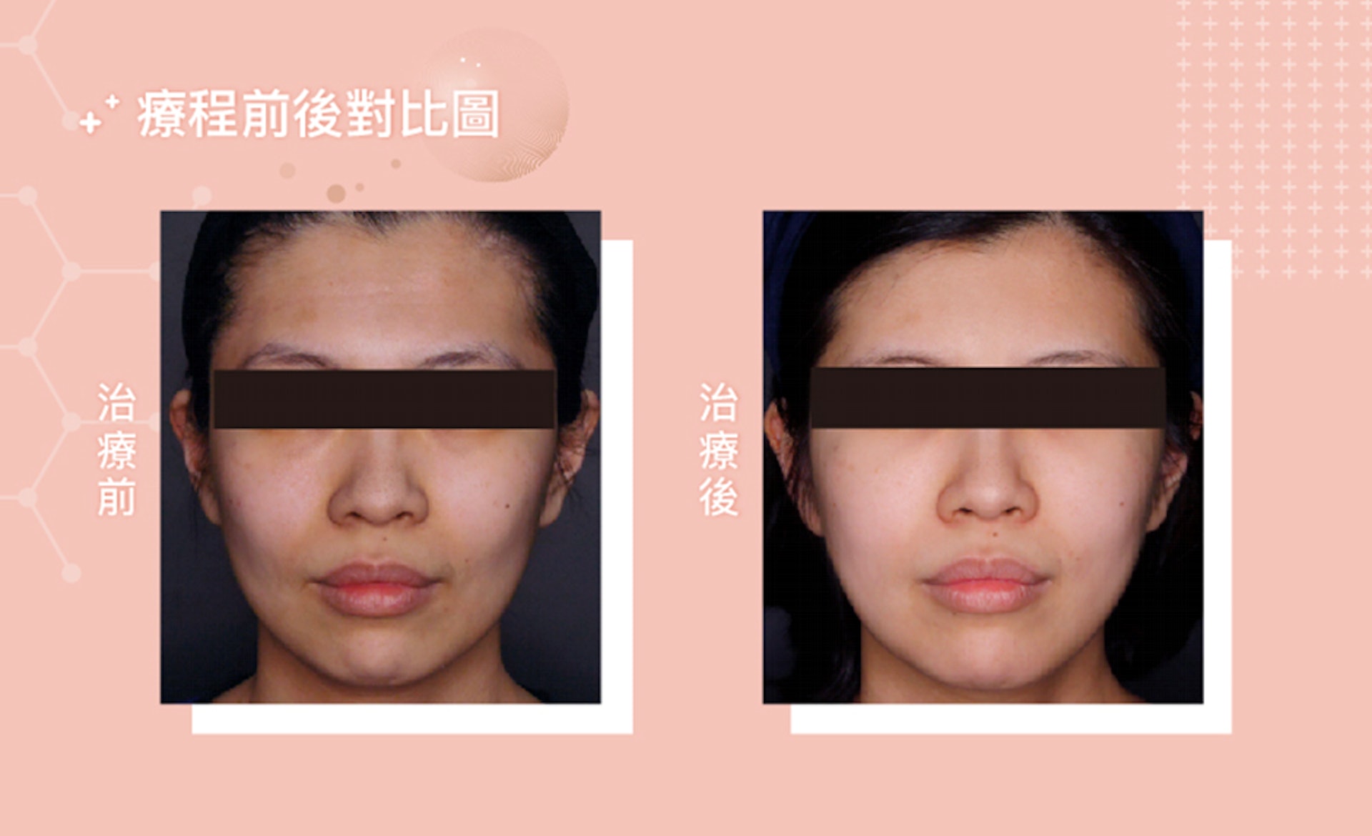 AestheFill®精靈針療程前後對比圖(圖片:Blisses Medical Clinic) AestheFill®精靈針療程前後對比圖(圖片:Blisses Medical Clinic)