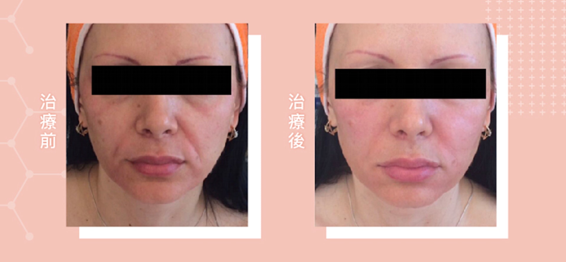AestheFill®精靈針療程前後對比圖(圖片:Blisses Medical Clinic) AestheFill®精靈針療程前後對比圖(圖片:Blisses Medical Clinic)