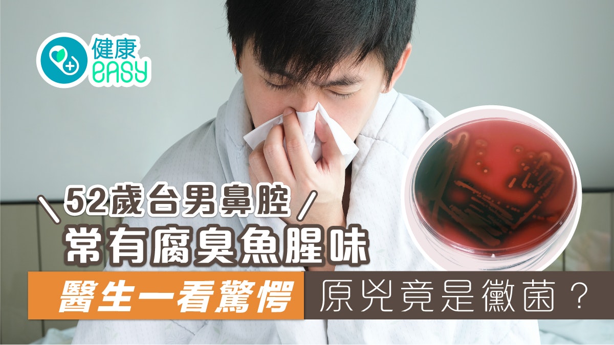 鼻竇炎|52歲台男鼻腔常有腐臭魚腥味 罪魁禍首竟是這東西 鼻竇炎|52歲台男鼻腔常有腐臭魚腥味 罪魁禍首竟是這東西