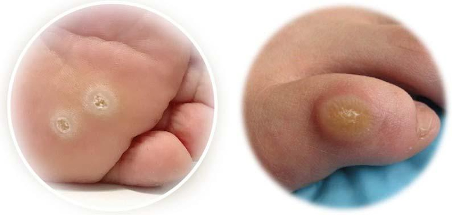（圖左）足底疣與(圖右)雞眼相似，細心觀察，足底疣有微小黑點，小黑點隨病毒擴散數量而增多。