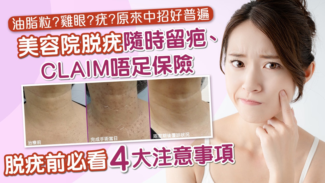 脫疣推薦 I 坊間脫疣服務如何選擇?無菌空間醫生處理最可靠 脫疣推薦 I 坊間脫疣服務如何選擇?無菌空間醫生處理最可靠