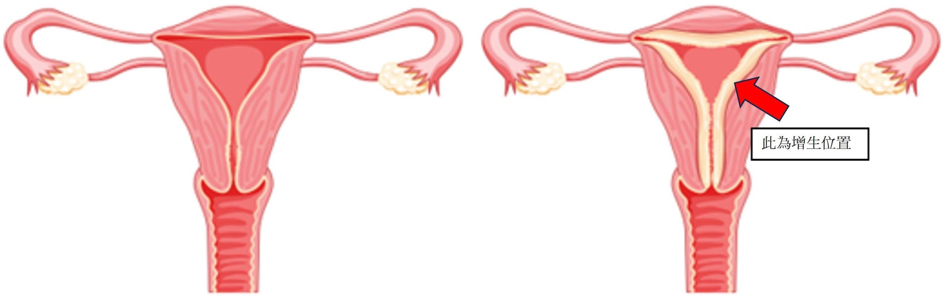 雌激素會刺激子宮內膜細胞過度增生，當缺乏黃體素制衡，便會造成子宮內膜增生。(左為正常子宮、右為子宮內膜增生)