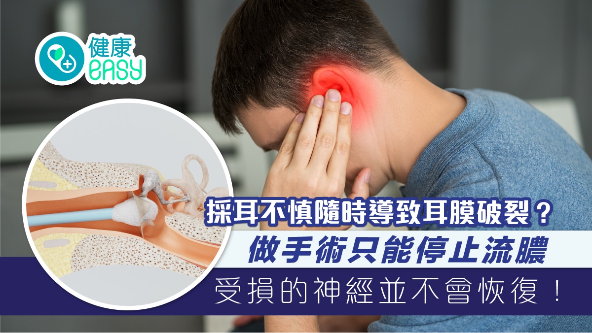 耳鳴｜採耳不慎恐留耳鳴後遺症？耳膜破裂嚴重難癒合或需手術修補