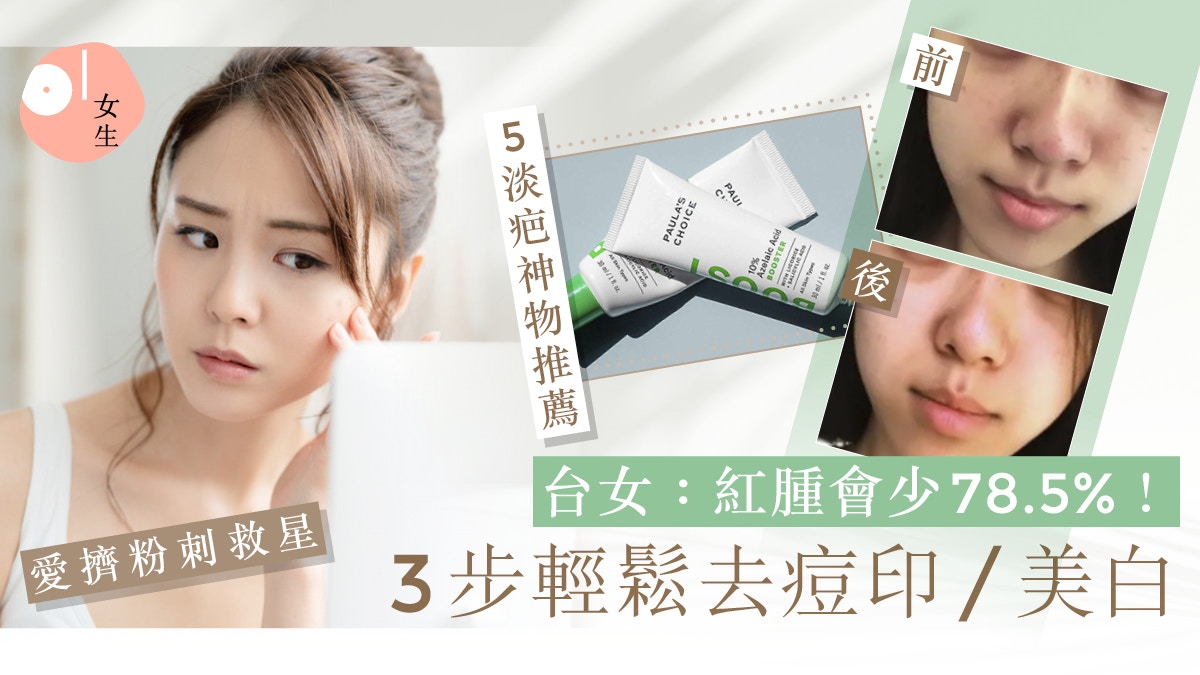 去痘印產品｜台女實試3招有效消痘疤方法附5大淡疤神物推薦