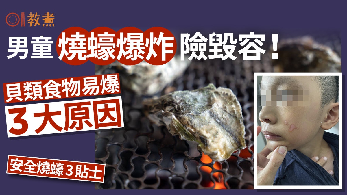 燒蠔意外｜男童燒蠔爆炸險毀容！貝類易爆3原因店主教正確燒蠔3步