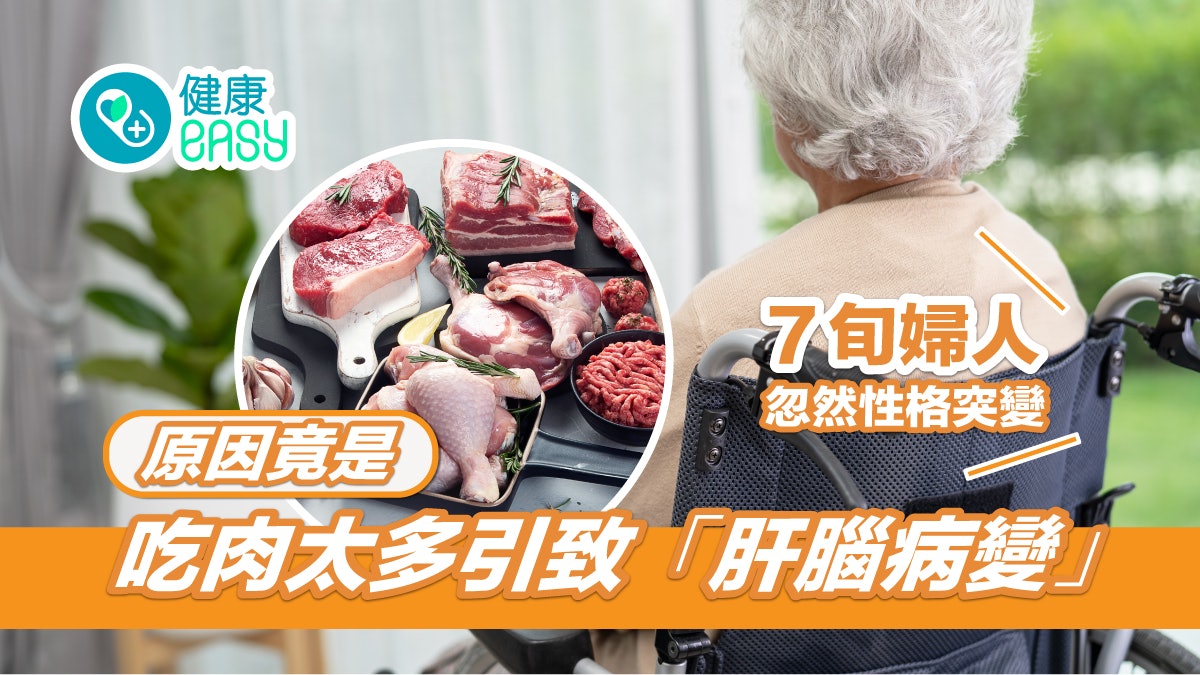肝衰竭|7旬婦人性格突變 原因竟是吃肉太多引致「肝腦病變」 肝衰竭|7旬婦人性格突變 原因竟是吃肉太多引致「肝腦病變」