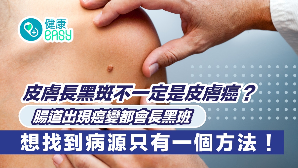 癌症｜手指腳趾現黑色斑塊一定是皮膚癌？恐大腸出問題需完整檢查