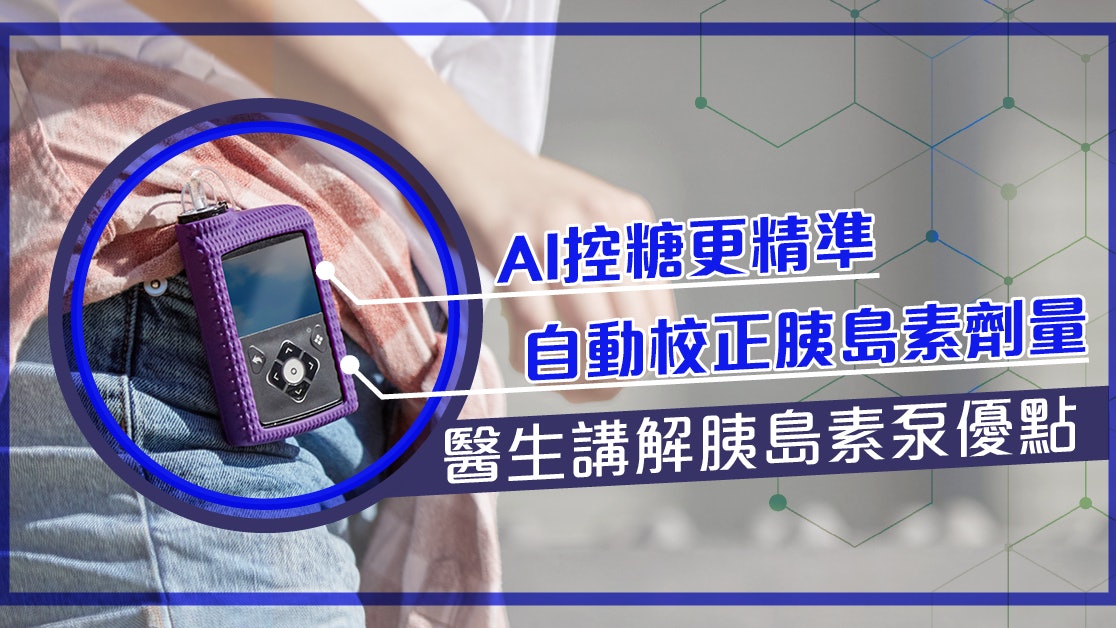 一型糖尿病人一定要打針?醫生拆解AI胰島素泵點幫病人自動控糖 一型糖尿病人一定要打針?醫生拆解AI胰島素泵點幫病人自動控糖