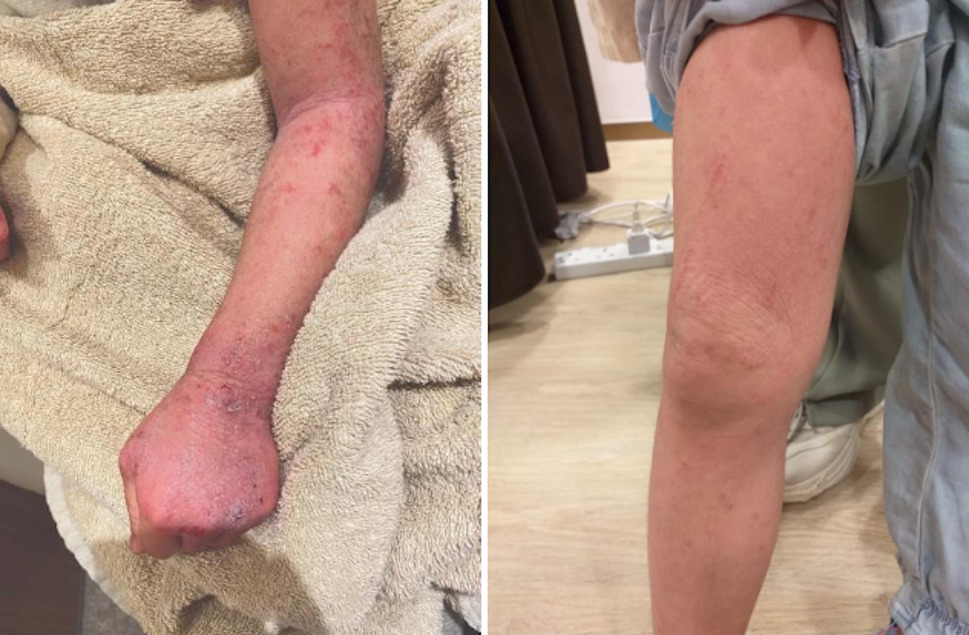 Emma 2歲時全身近九成皮膚患有濕疹，尤其手、腳皮膚相對嚴重。
