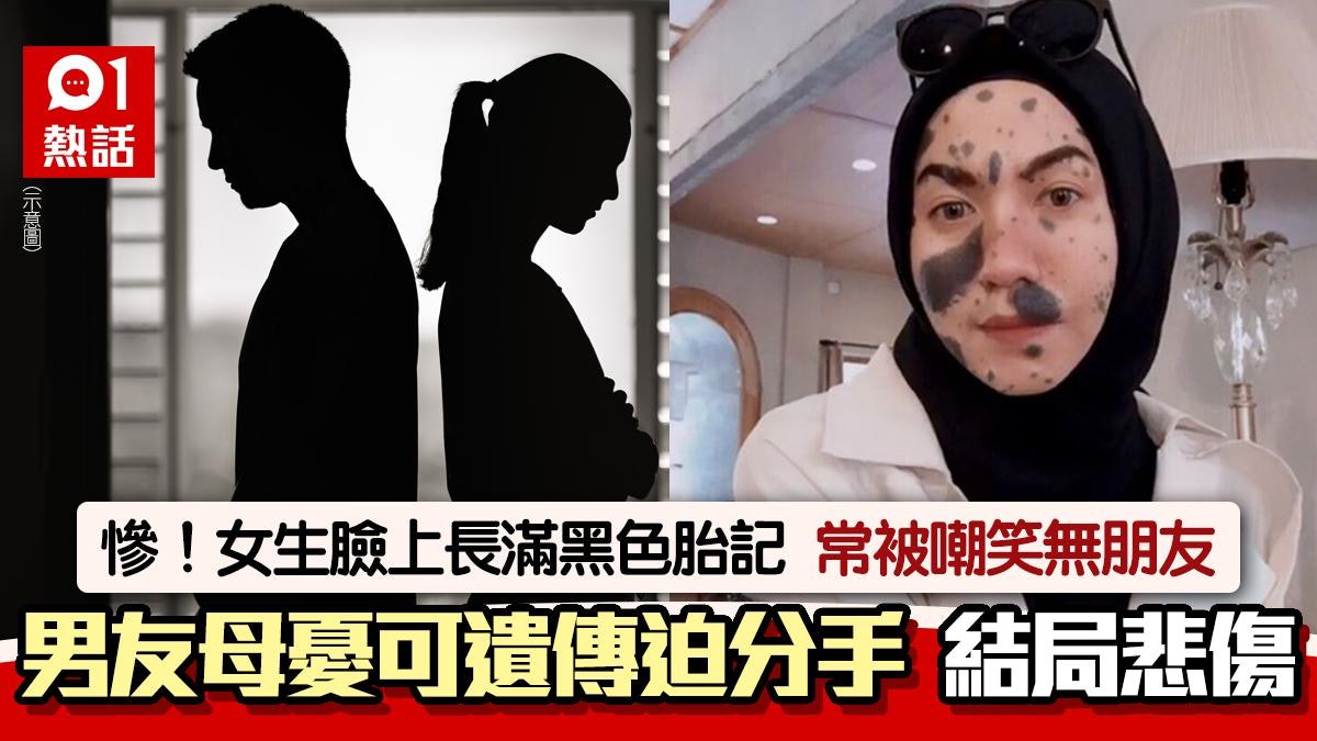 女生滿臉胎記被嘲笑!男友家人憂「遺傳後代」 強迫分手結局慘 女生滿臉胎記被嘲笑!男友家人憂「遺傳後代」 強迫分手結局慘