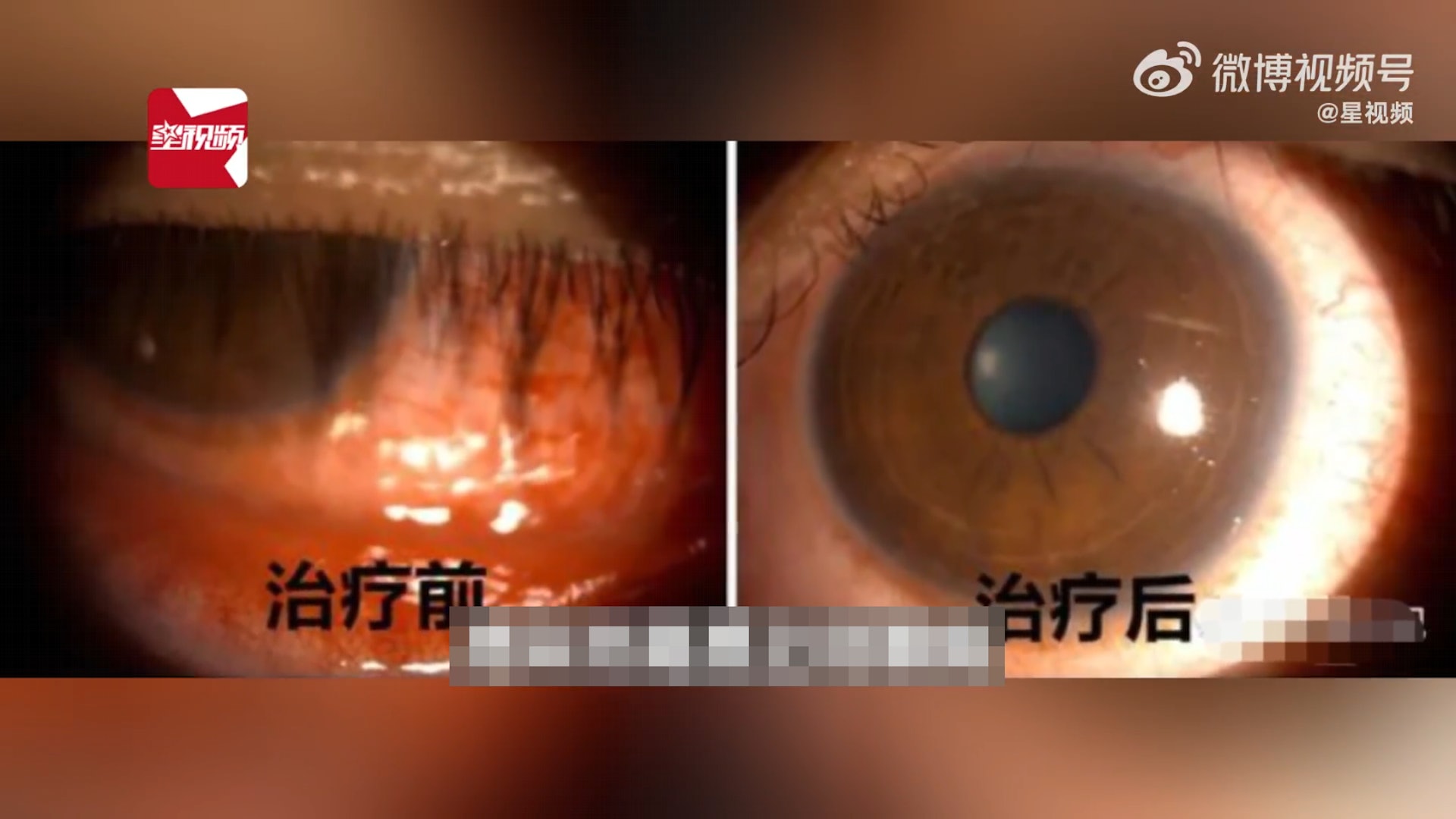 廣西南寧一名30歲男子,日前出現雙眼紅腫、眼痛、流淚、尿痛等症狀。(星視頻) 廣西南寧一名30歲男子,日前出現雙眼紅腫、眼痛、流淚、尿痛等症狀。(星視頻)