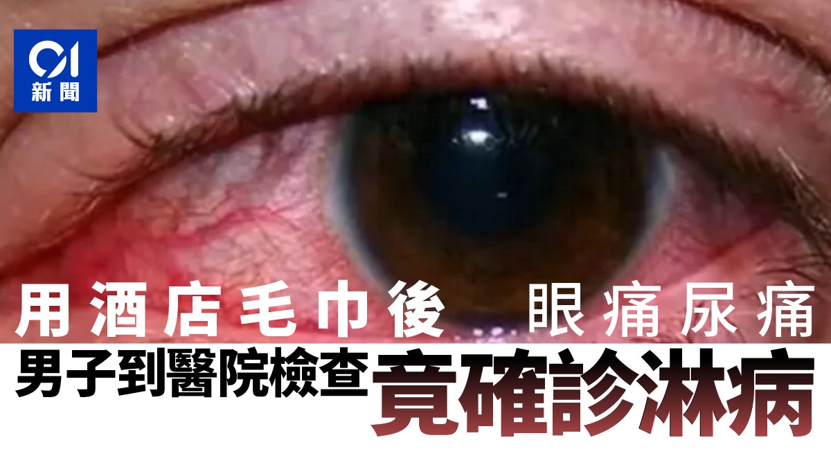廣西男眼痛尿痛 檢查後確診淋病 醫院驚揭感染源竟是酒店毛巾 廣西男眼痛尿痛 檢查後確診淋病 醫院驚揭感染源竟是酒店毛巾