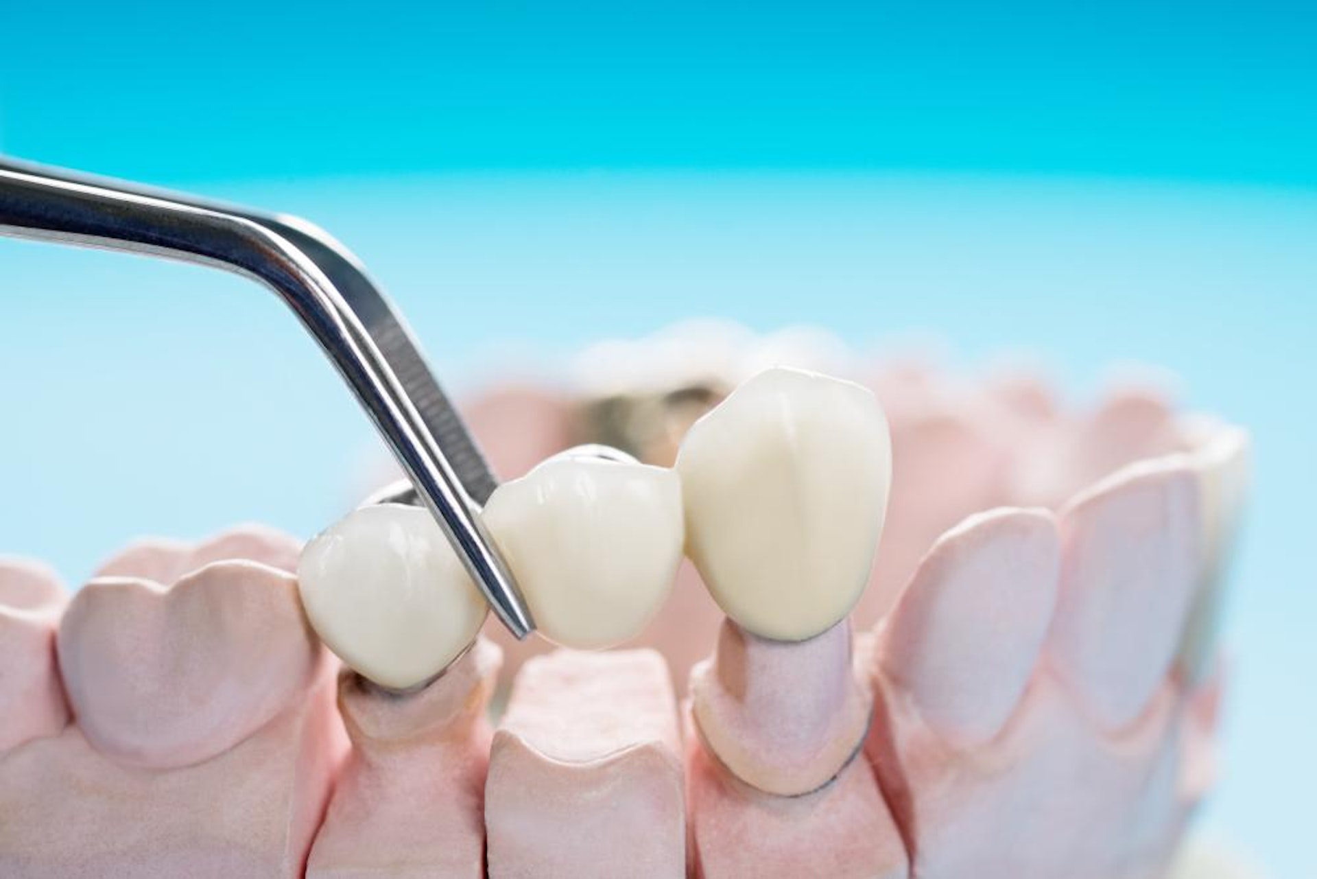 牙橋，即是將缺牙旁邊兩隻牙或前後兩隻牙作為橋樑，以「缺一補三」的形式做一個牙套，牙套中間為義齒一起套上。（圖片：Shuttestock）