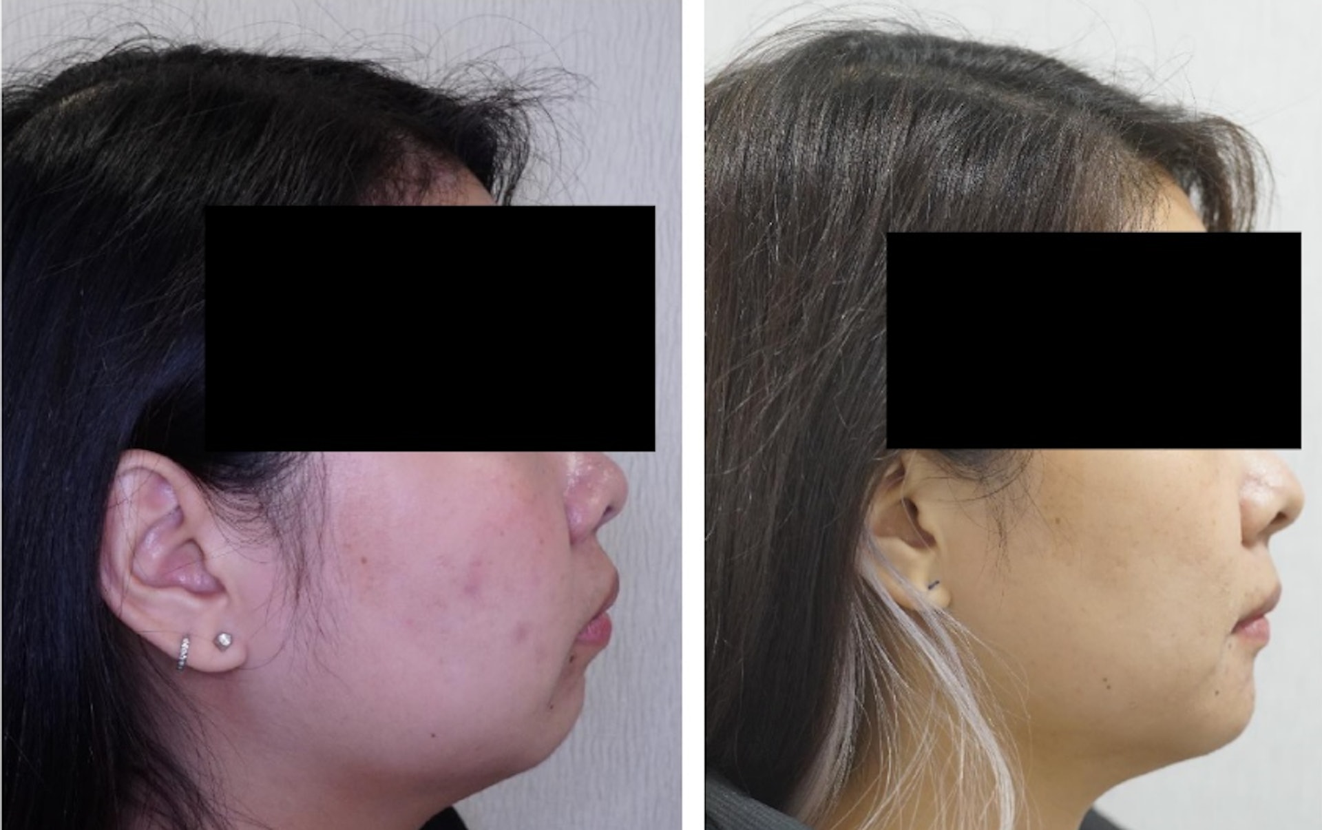 於合適個案中,箍牙可以改善面型。(圖片:Starry Smile Dental Centre) 於合適個案中,箍牙可以改善面型。(圖片:Starry Smile Dental Centre)