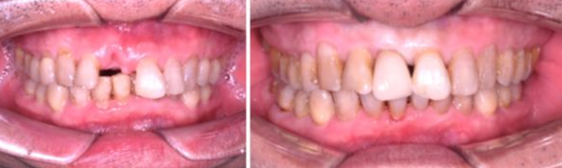 圖中為一名中年男性在植牙前(左)，到箍牙再植牙治療後(右)的分別。（圖片：Starry Smile Dental Centre）