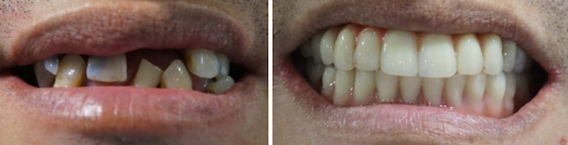 All-on-4/5/6 的前（左）後（右）對比。（圖片：Starry Smile Dental Centre）