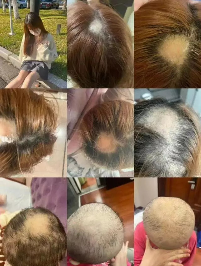 19歲女染髮後7天現嚴重脫髮恐永久光頭！醫生：6類人不建議染髮